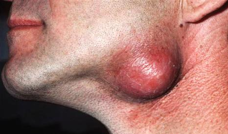 葛根加盟,戒檳榔項目,葛根品牌,中型囊腫